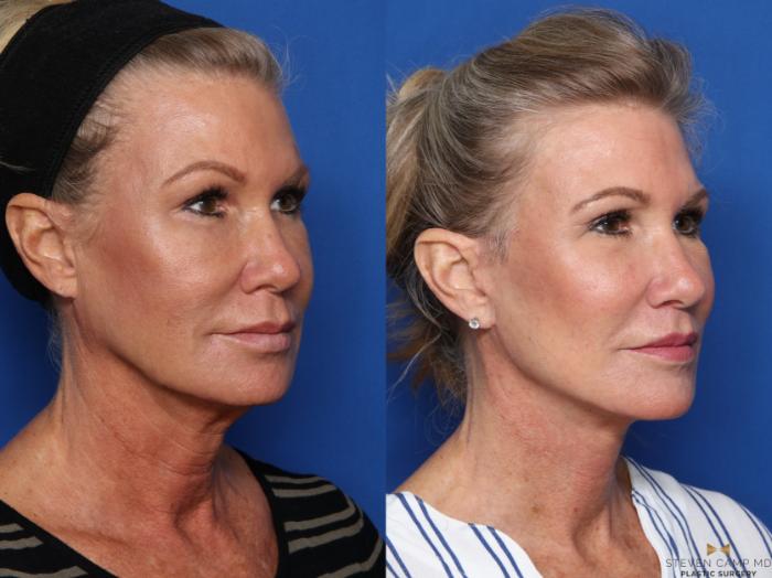 Before & After Facelift Case 469 Right Oblique View in Fort Worth & Arlington, Texas