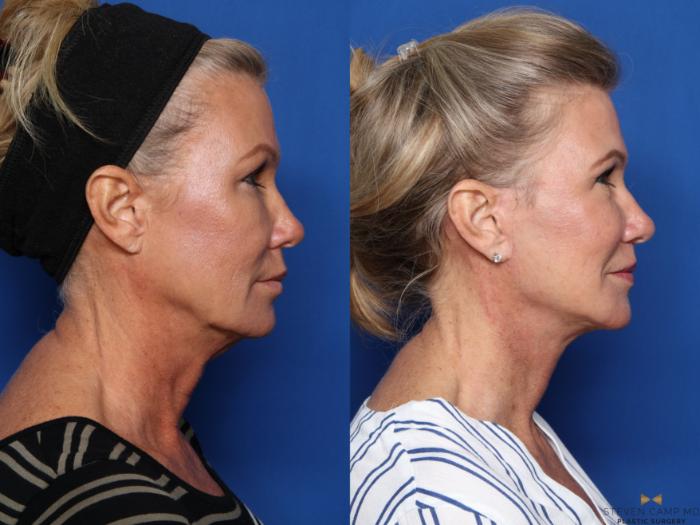 Before & After Necklift Case 469 Right Side View in Fort Worth & Arlington, Texas