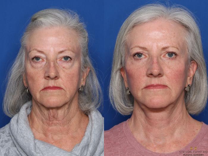 Before & After Facelift Case 473 Front View in Fort Worth, Texas