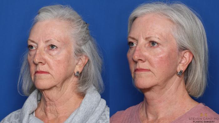 Before & After Facelift Case 473 Left Oblique View in Fort Worth, Texas