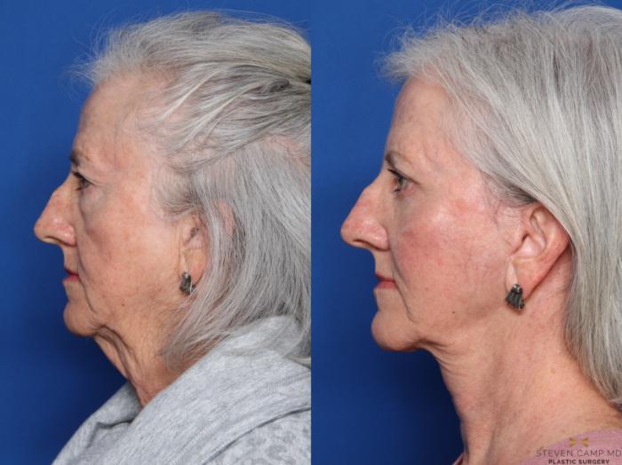 Before & After Facelift Case 473 Left Side View in Fort Worth, Texas