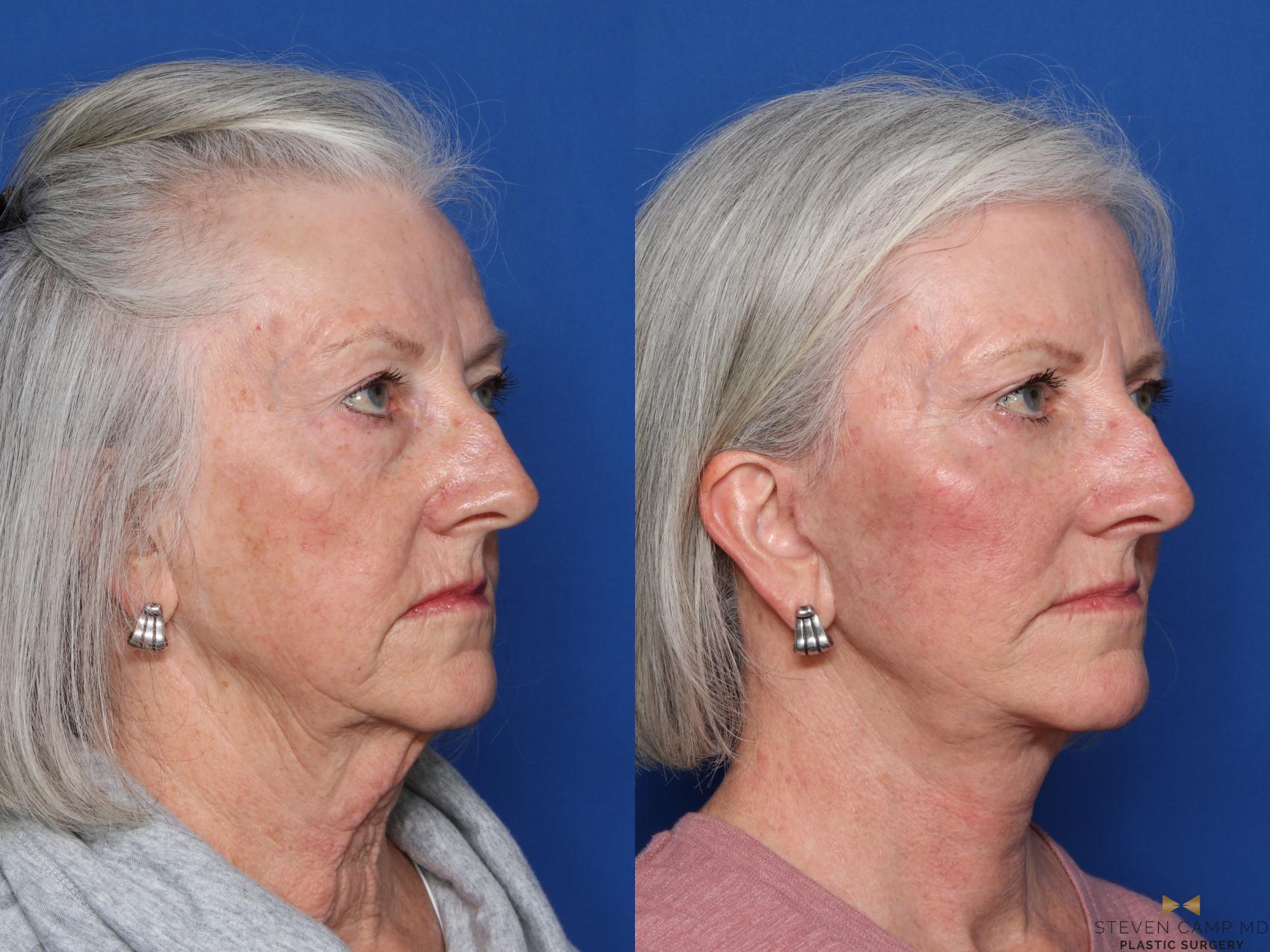 Before & After Facelift Case 473 Right Oblique View in Fort Worth, Texas