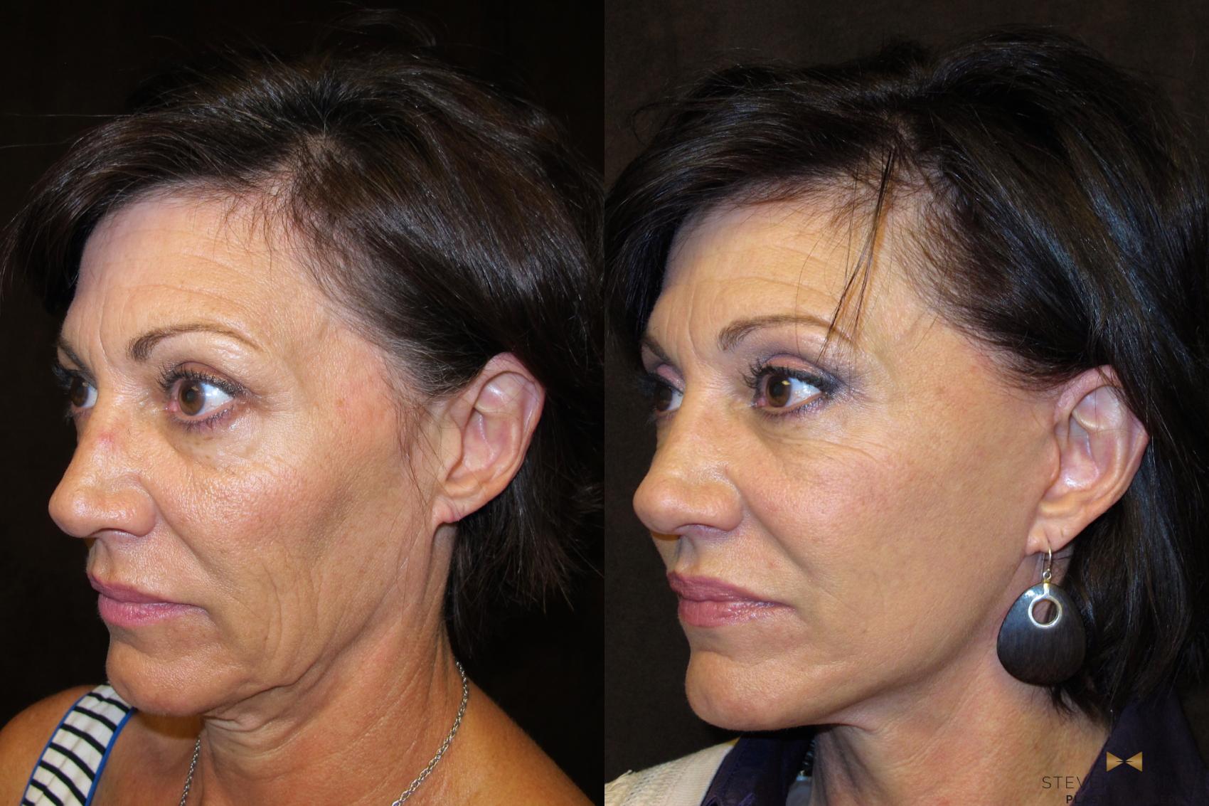 Before & After Facelift Case 50 View #1 View in Fort Worth & Arlington, Texas