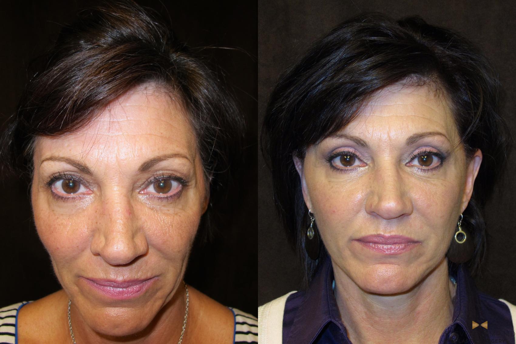 Before & After Facelift Case 50 View #2 View in Fort Worth, Texas