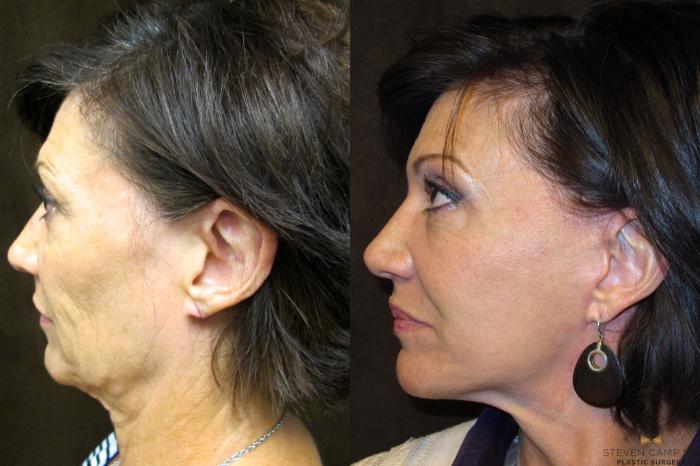 Before & After Facelift Case 50 View #3 View in Fort Worth & Arlington, Texas