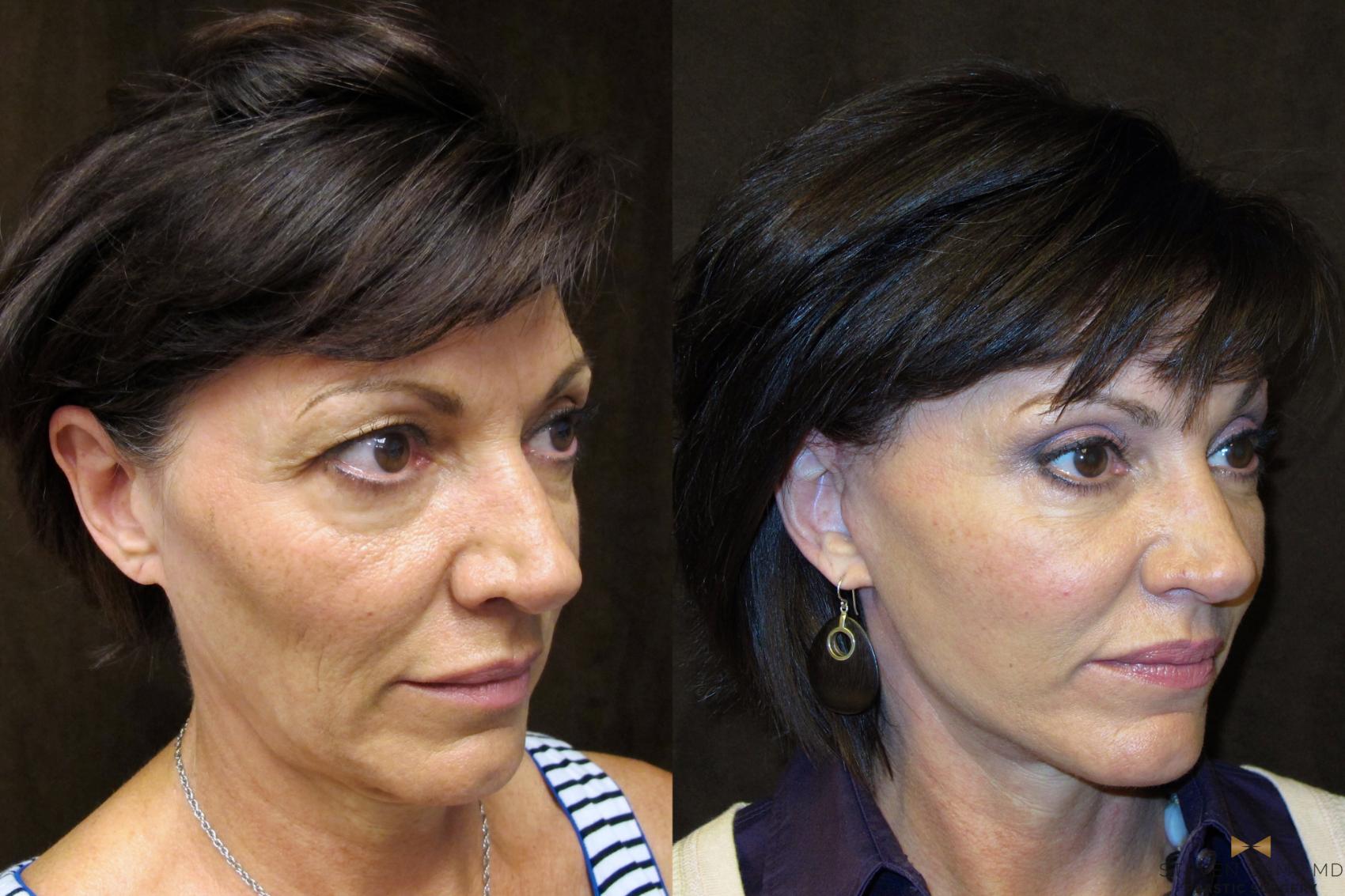 Before & After Facelift Case 50 View #4 View in Fort Worth, Texas