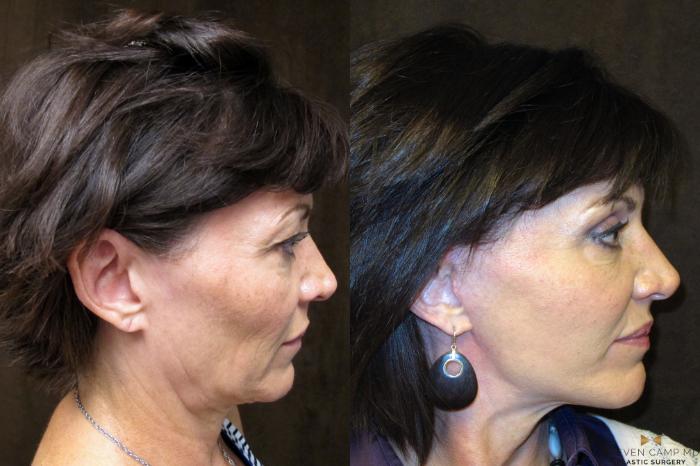 Before & After Necklift Case 50 View #5 View in Fort Worth & Arlington, Texas