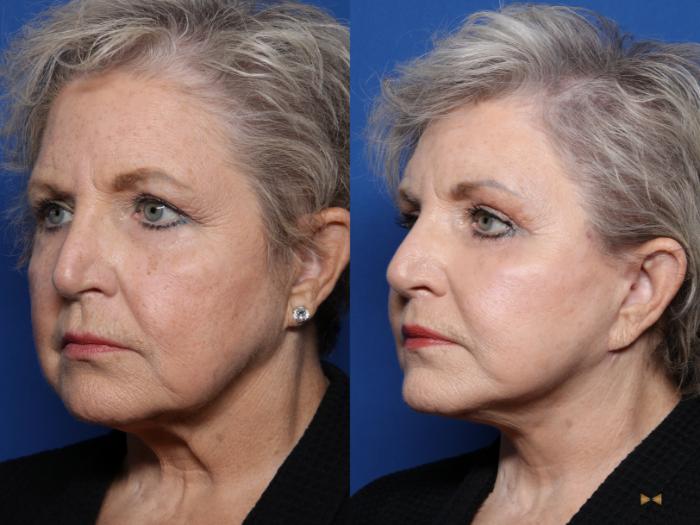 Before & After Facelift Case 511 Left Oblique View in Fort Worth, Texas