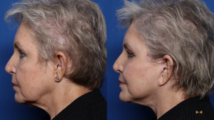 Before & After Blepharoplasty Case 511 Left Side View in Fort Worth & Arlington, Texas