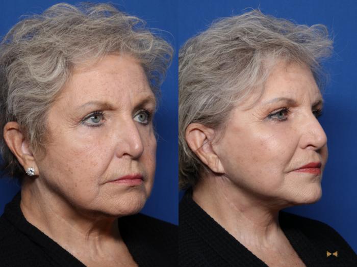 Before & After Blepharoplasty Case 511 Right Oblique View in Fort Worth & Arlington, Texas