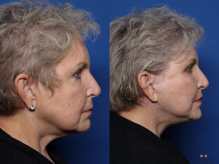 Before & After Blepharoplasty Case 511 Right Side View in Fort Worth & Arlington, Texas