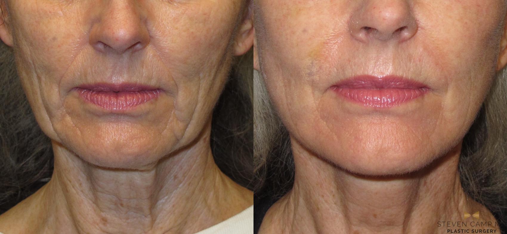 Before & After Facelift Case 52 View #1 View in Fort Worth & Arlington, Texas