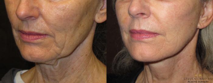 Before & After Necklift Case 52 View #2 View in Fort Worth & Arlington, Texas