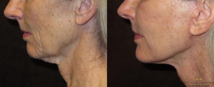 Before & After Necklift Case 52 View #3 View in Fort Worth & Arlington, Texas