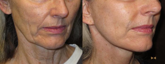 Before & After Necklift Case 52 View #4 View in Fort Worth & Arlington, Texas