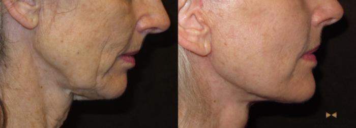 Before & After Necklift Case 52 View #5 View in Fort Worth & Arlington, Texas