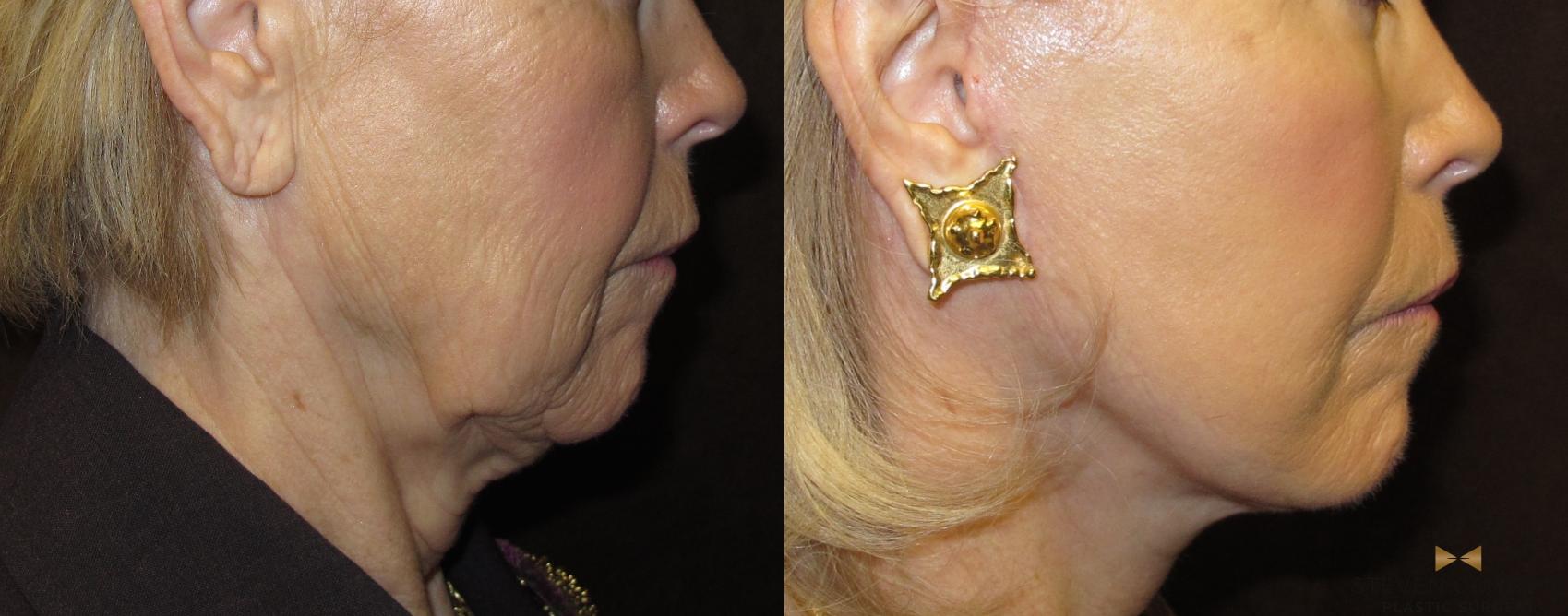 Before & After Facelift Case 53 View #1 View in Fort Worth & Arlington, Texas