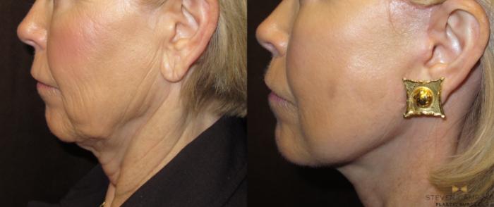 Before & After Facelift Case 53 View #2 View in Fort Worth & Arlington, Texas