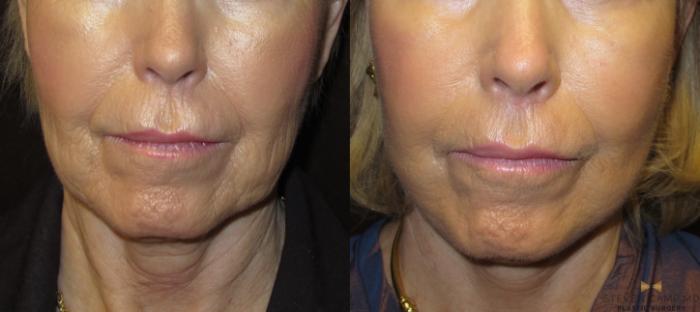 Before & After Facelift Case 53 View #3 View in Fort Worth & Arlington, Texas