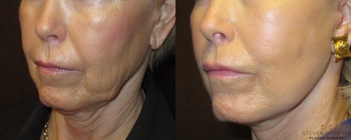 Before & After Necklift Case 53 View #4 View in Fort Worth & Arlington, Texas