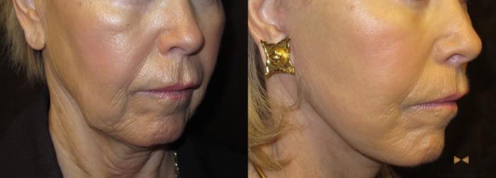 Before & After Facelift Case 53 View #5 View in Fort Worth & Arlington, Texas
