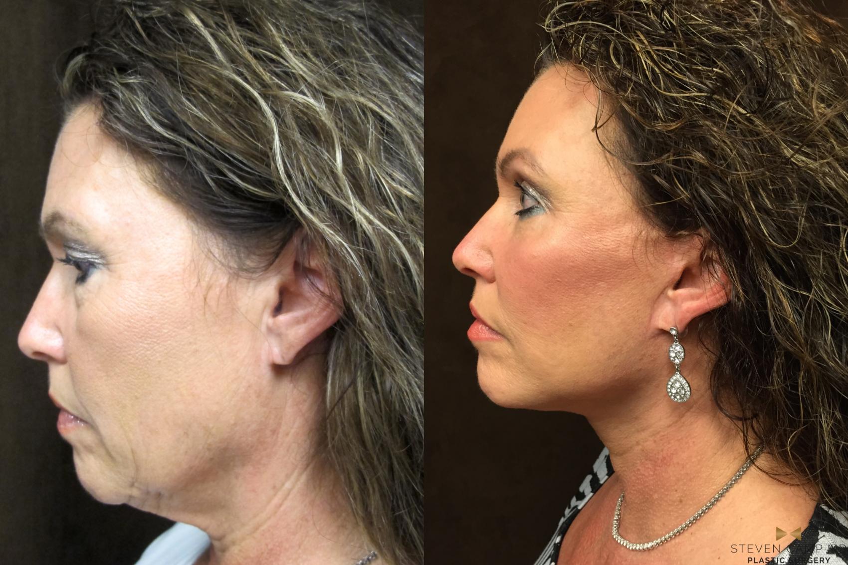 Before & After Necklift Case 54 View #1 View in Fort Worth & Arlington, Texas