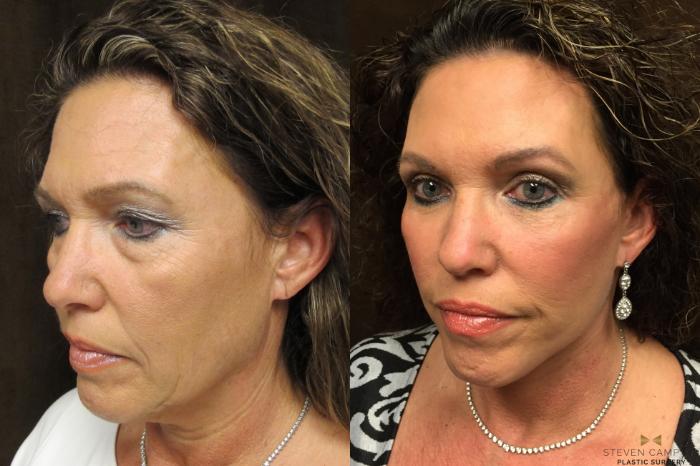 Before & After Facelift Case 54 View #4 View in Fort Worth, Texas