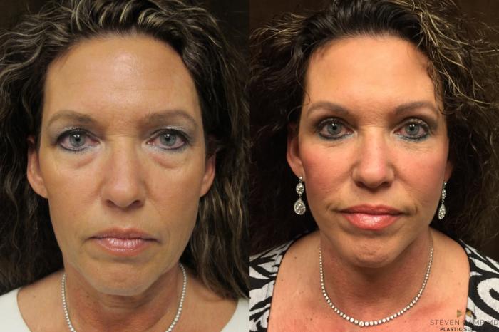 Before & After Facelift Case 54 View #5 View in Fort Worth, Texas