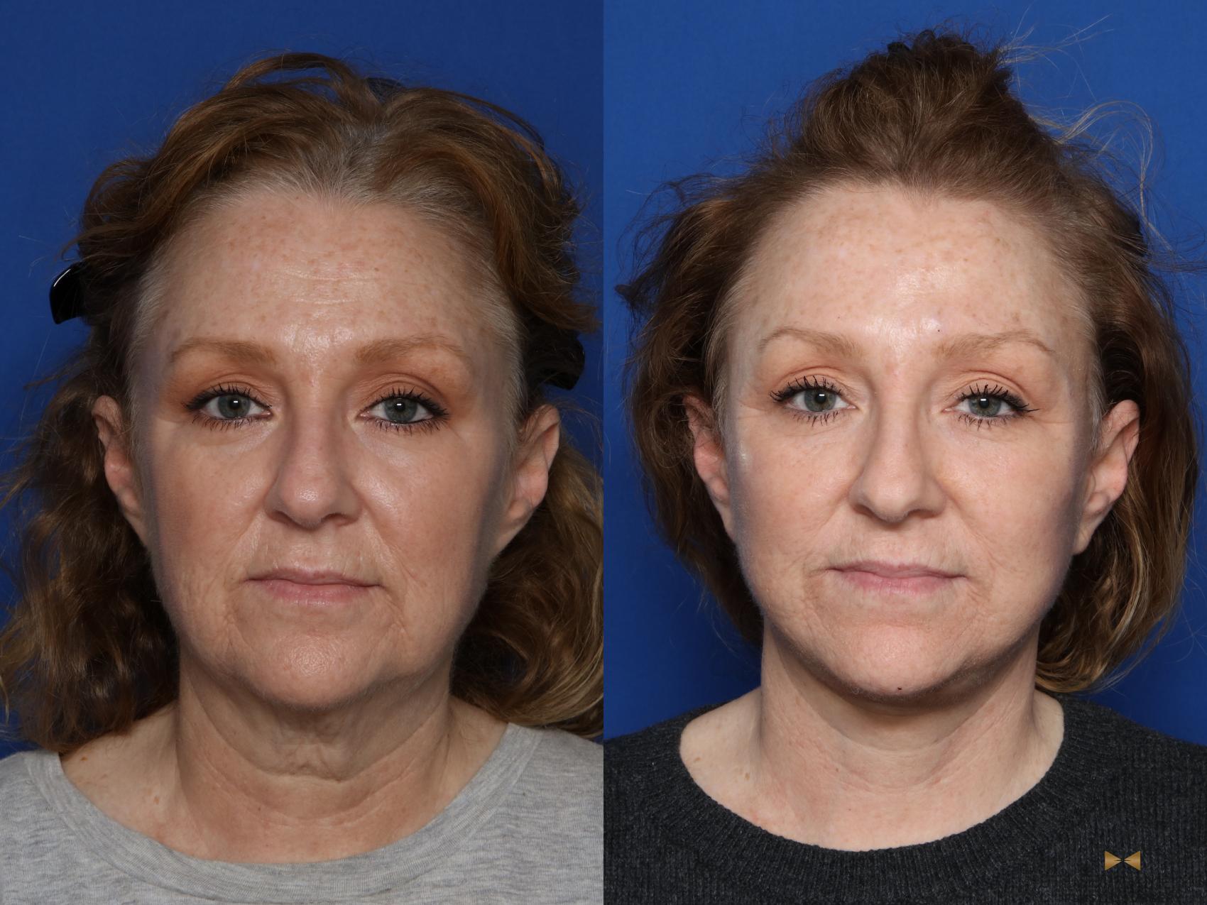 Before & After BOTOX Case 567 Front View in Fort Worth & Arlington, Texas