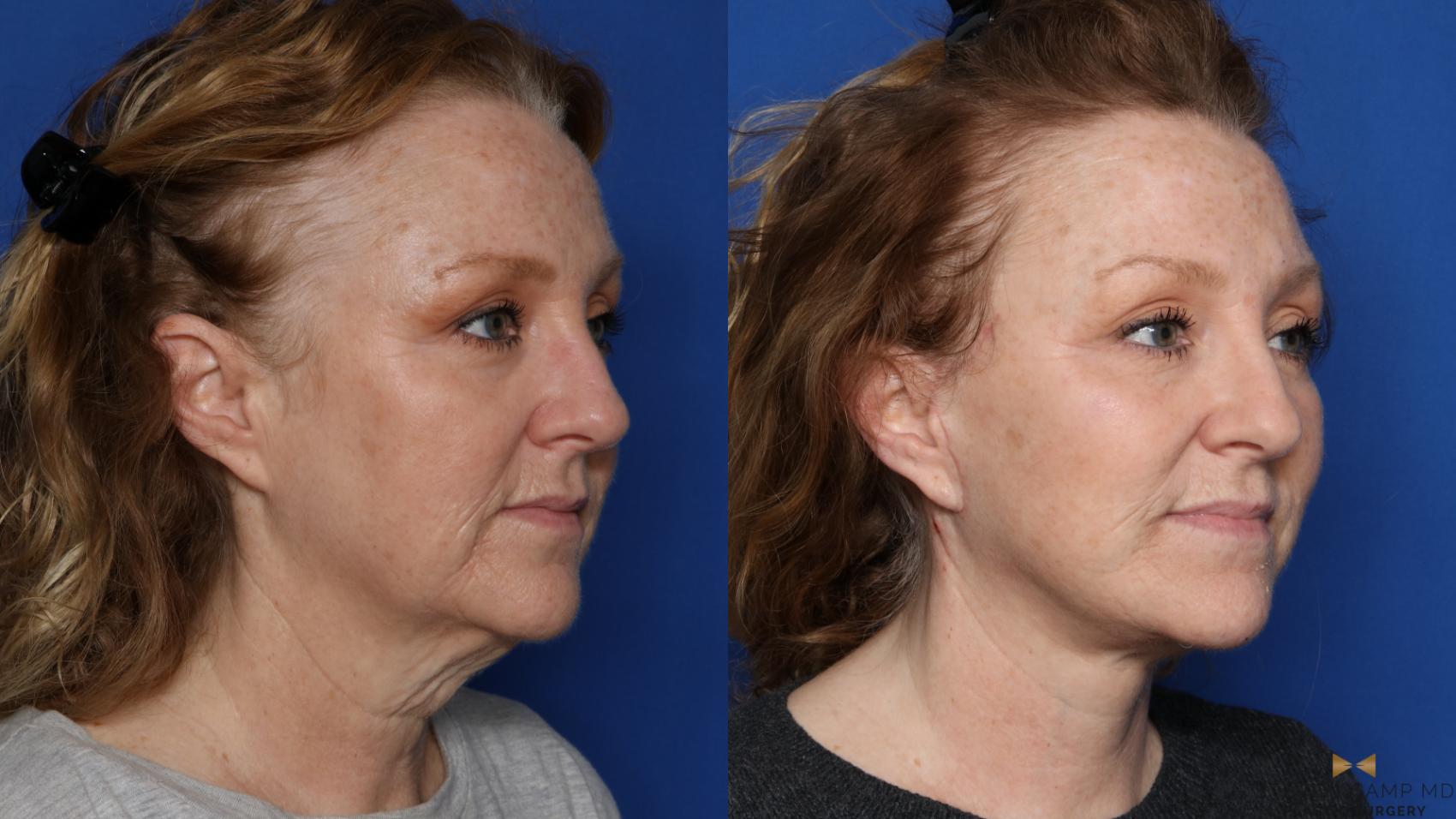 Before & After Facelift Case 567 Right Oblique View in Fort Worth, Texas