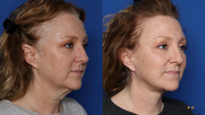 Before & After Facelift Case 567 Right Oblique View in Fort Worth & Arlington, Texas