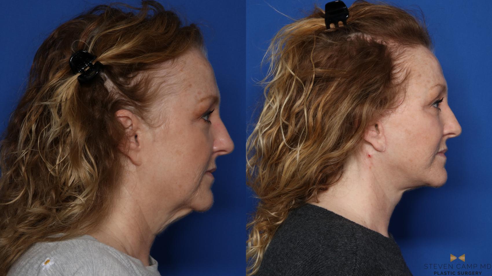 Before & After Facelift Case 567 Right Side View in Fort Worth, Texas