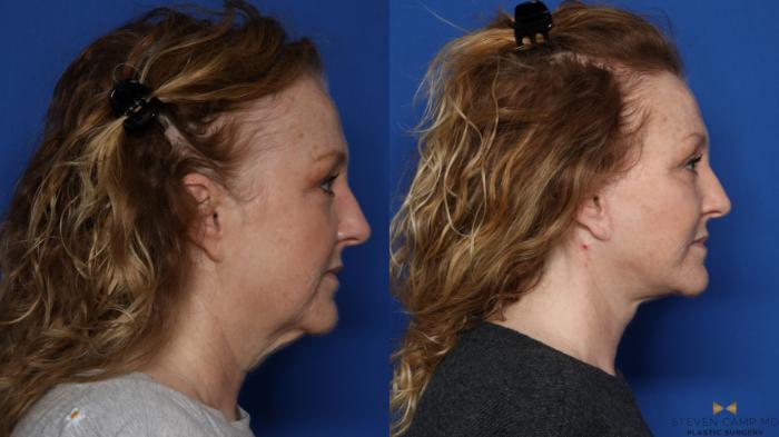 Before & After Sciton Laser Case 567 Right Side View in Fort Worth & Arlington, Texas