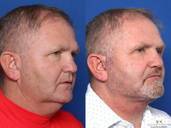Before & After Facelift Case 609 Right Oblique View in Fort Worth & Arlington, Texas