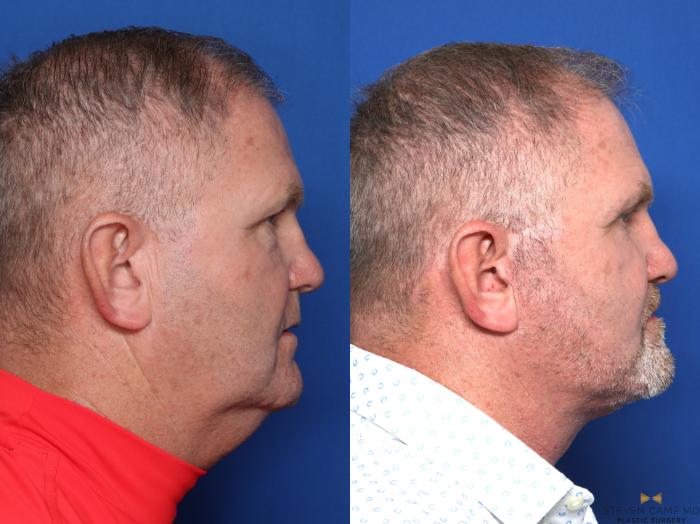 Before & After Sciton Laser Case 609 Right Side View in Fort Worth & Arlington, Texas