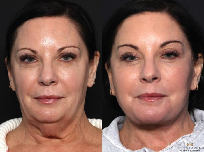 Before & After Necklift Case 643 Front View in Fort Worth & Arlington, Texas