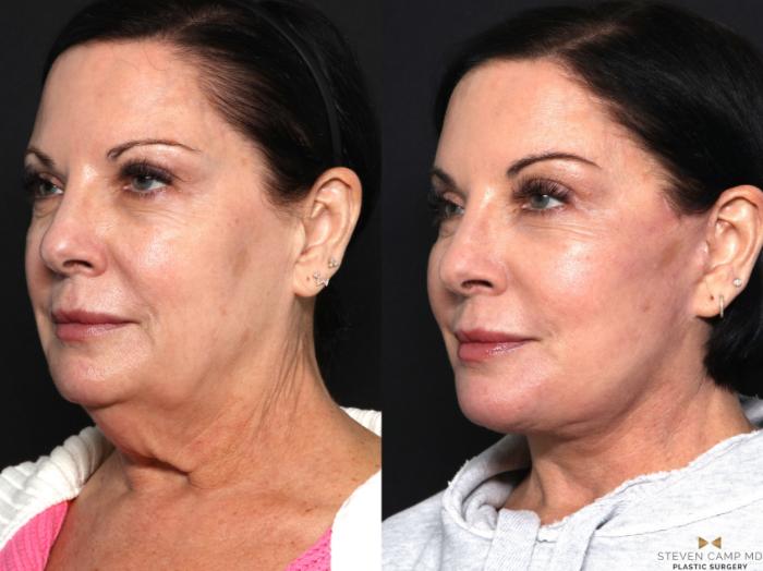 Before & After Facelift Case 643 Left Oblique View in Fort Worth & Arlington, Texas