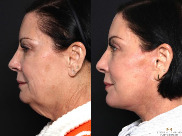 Before & After Necklift Case 643 Left Side View in Fort Worth & Arlington, Texas
