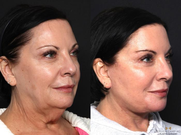 Before & After Facelift Case 643 Right Oblique View in Fort Worth & Arlington, Texas