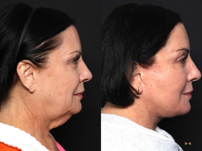 Before & After Sciton Laser Case 643 Right Side View in Fort Worth & Arlington, Texas