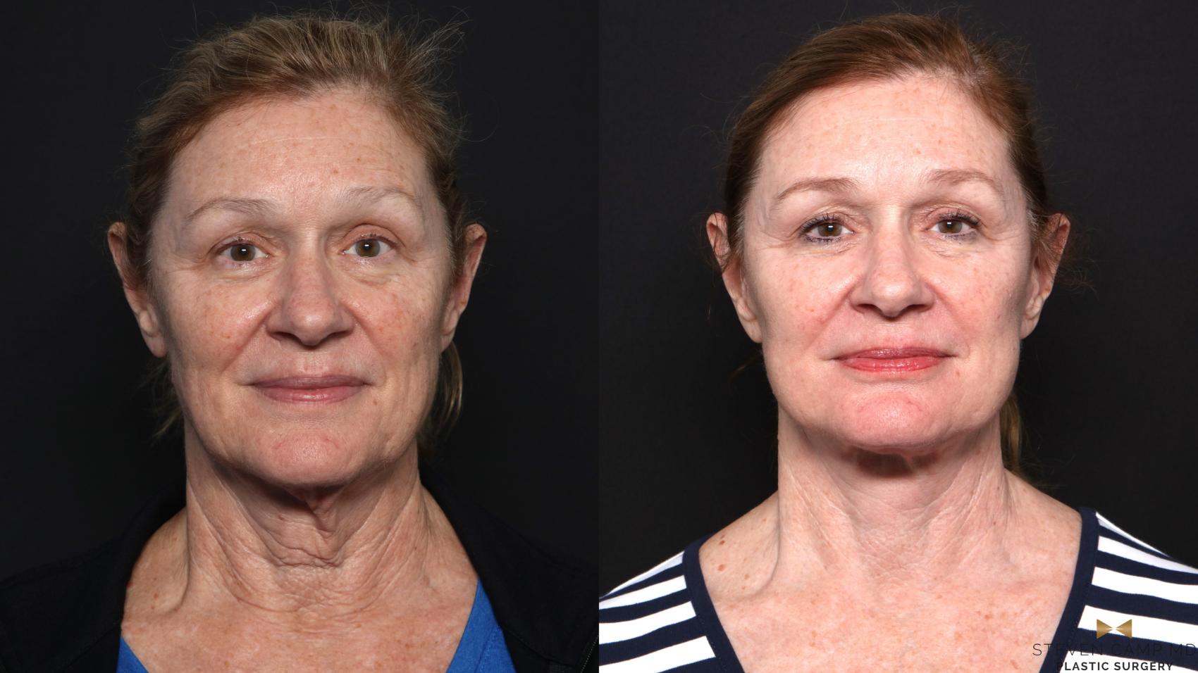 Before & After Facelift Case 666 Front View in Fort Worth & Arlington, Texas