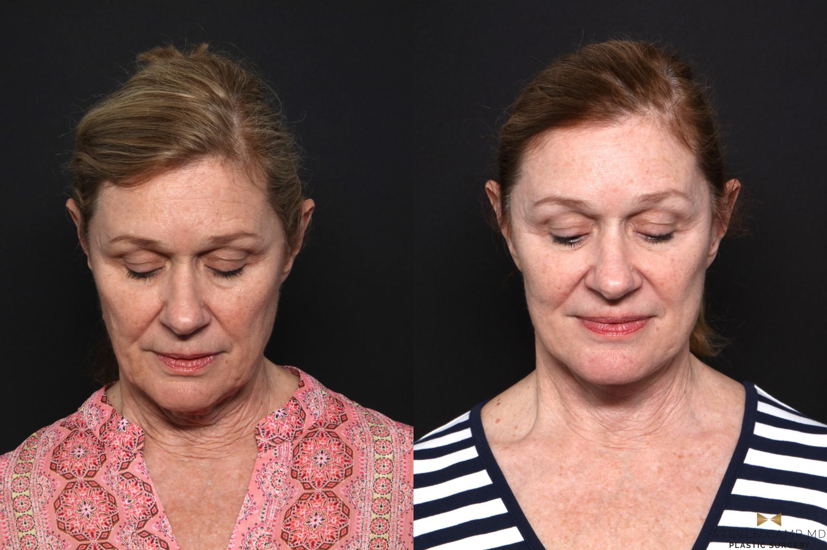 Before & After Necklift Case 666 Front looking down View in Fort Worth & Arlington, Texas
