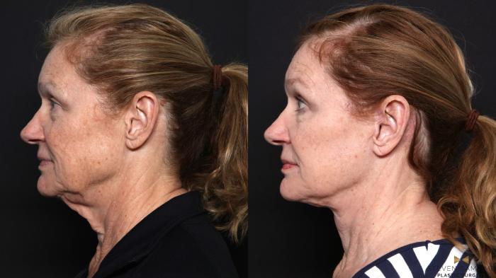 Before & After Facelift Case 666 Left Side View in Fort Worth & Arlington, Texas
