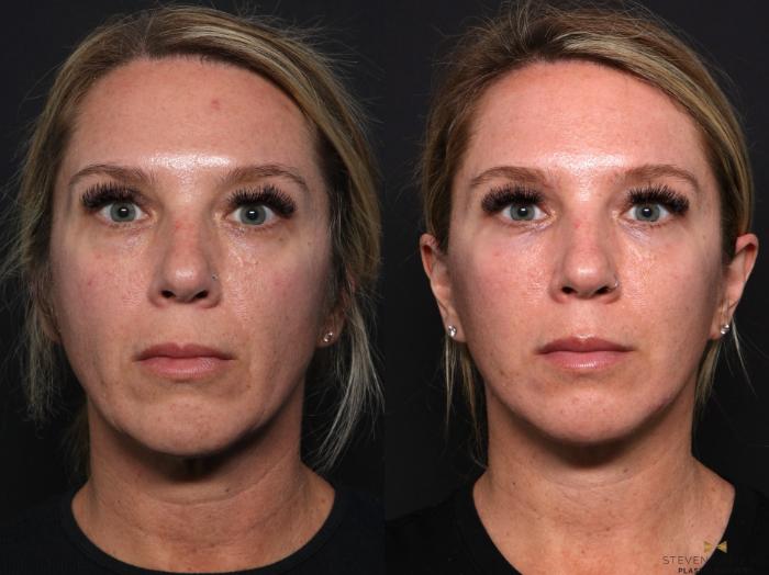 Before & After Necklift Case 667 Front View in Fort Worth & Arlington, Texas