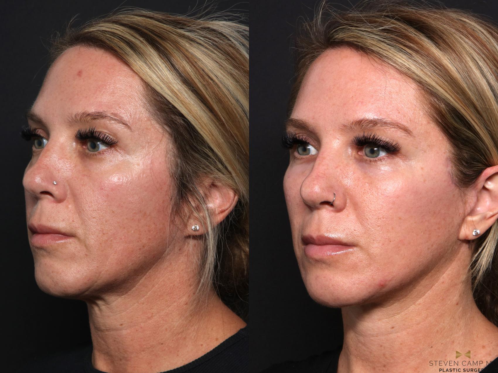Before & After Blepharoplasty Case 667 Left Oblique View in Fort Worth & Arlington, Texas