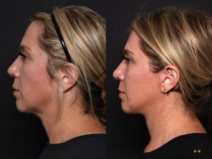 Before & After Necklift Case 667 Left Side View in Fort Worth & Arlington, Texas