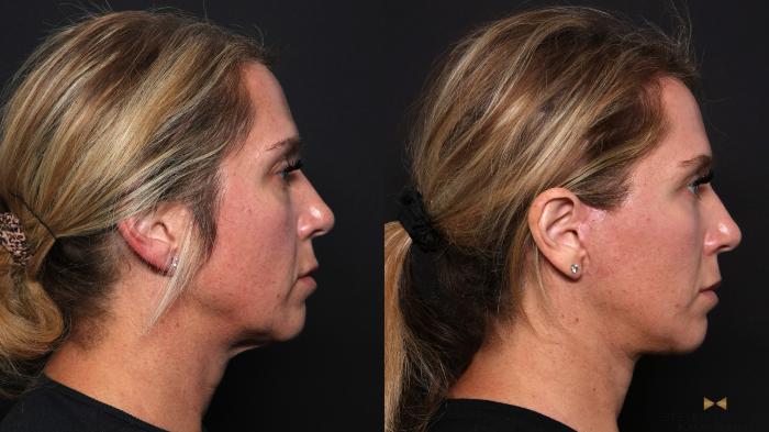 Before & After Sciton Laser Case 667 Right Side View in Fort Worth & Arlington, Texas