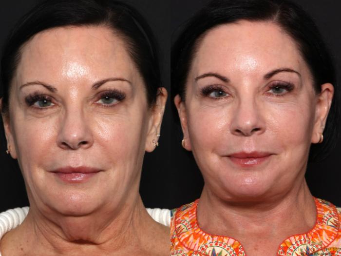 Before & After Facelift Case 681 Front View in Fort Worth & Arlington, Texas