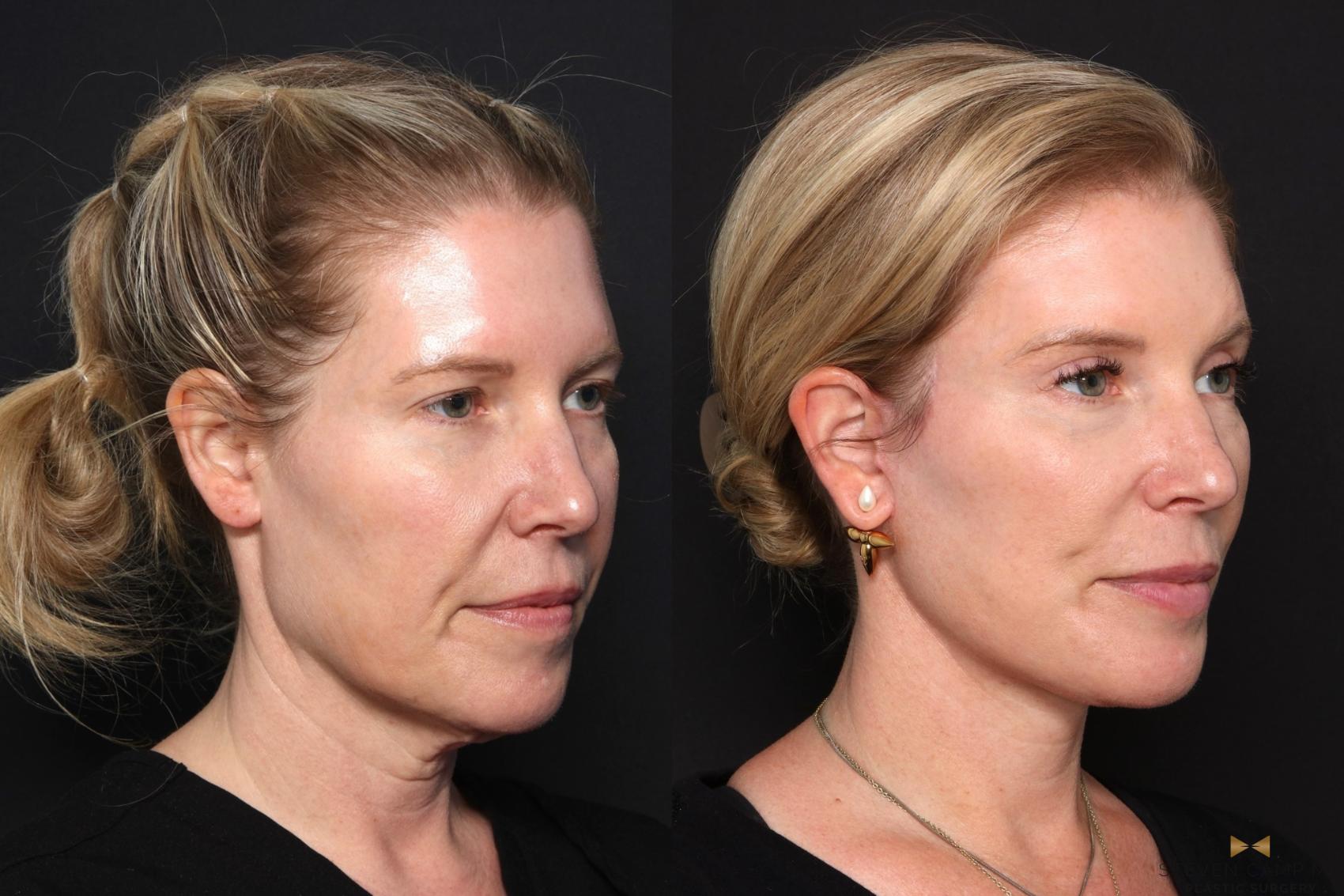 Before & After Facelift Case 682 Right Oblique View in Fort Worth & Arlington, Texas