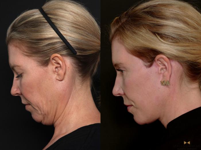 Before & After Necklift Case 687 Looking down left side  View in Fort Worth & Arlington, Texas